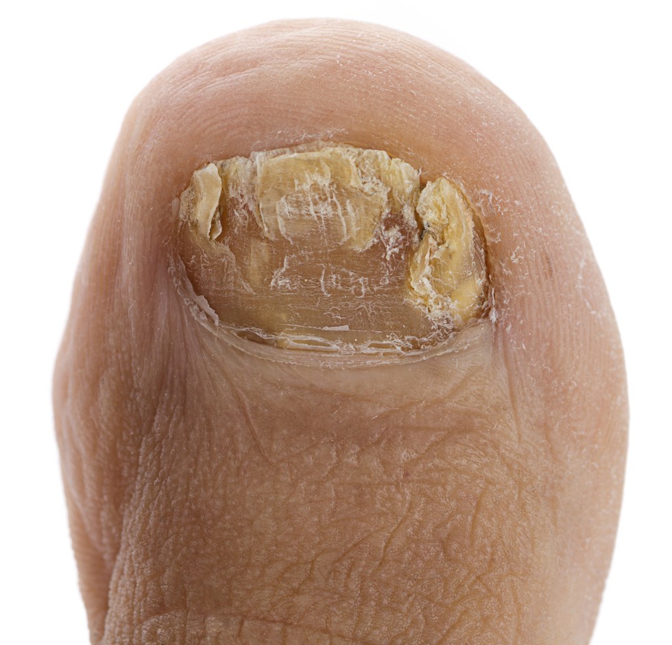 Bei diesen Symptomen solltest du einen HIV Test machen lassen - Fakten Guru