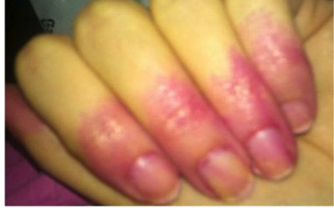 20 Absolutely Cringe Worthy Nail Fails Even Something Like Taking Your Nail Polish Fails Or Wins Off Of Nails Can Turn Into A Disaster It Takes Forever To Get The Skin Once