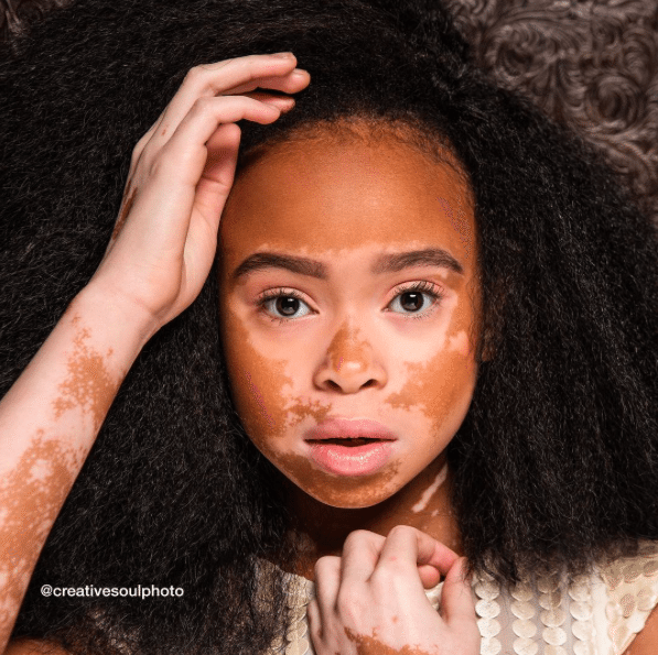 Winnie Harlow Surprises 10-Year-Old April Star With A Photo Shoot...And ...