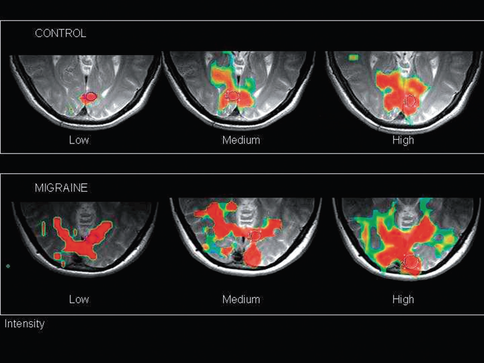 Living With Chronic Migraines And Cluster Headaches