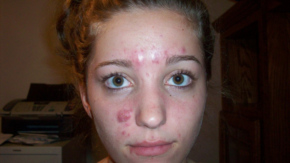 accutane genetic acne accutane genetic acne