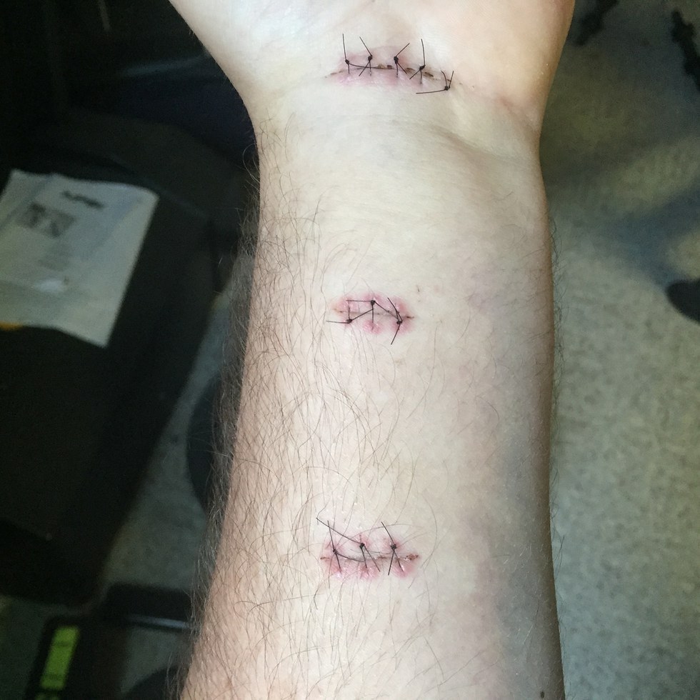 What I Have Learned Since Having Tommy John Surgery