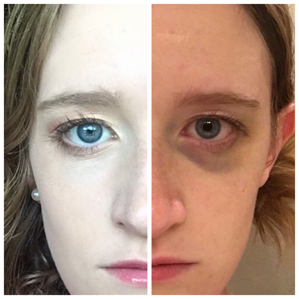 Best Makeup Concealer For Bruises Mugeek Vidalondon