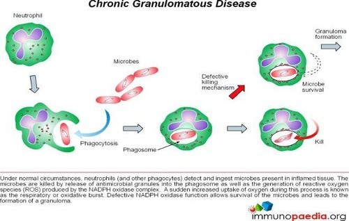 Granulomatous Disease, Chronic