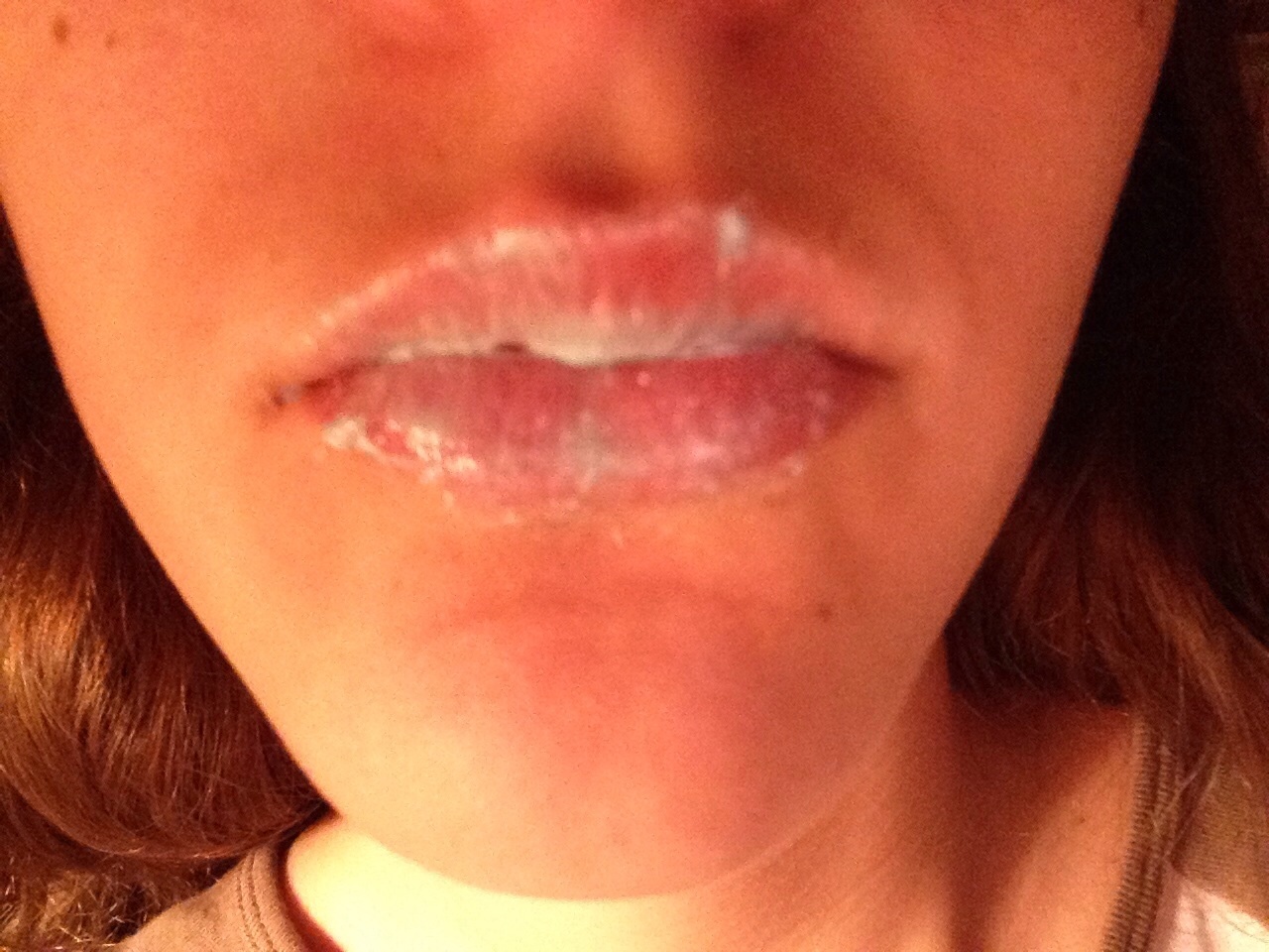 Do Your Lips Get Bigger On Accutane