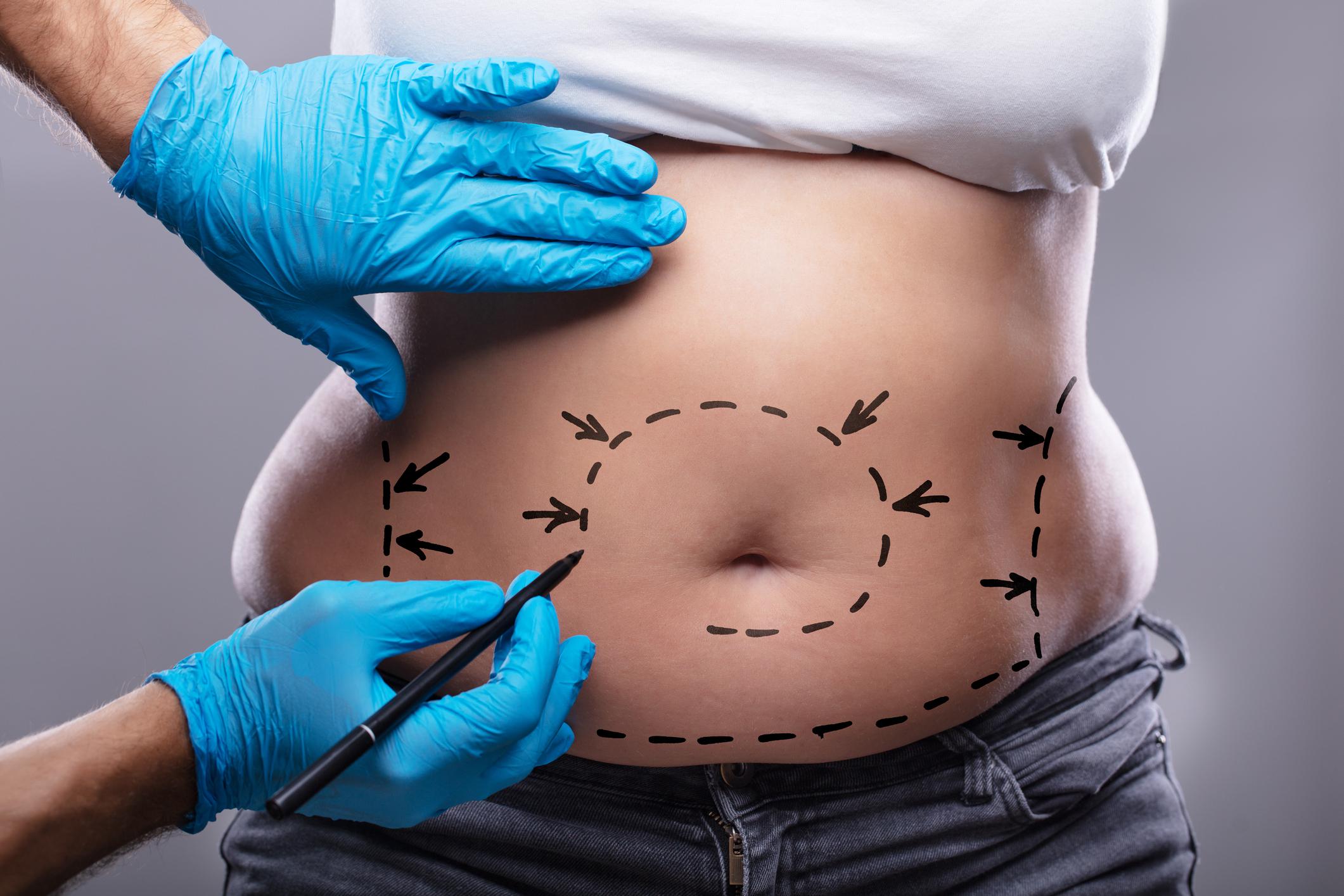 Am I A Good Candidate For A Tummy Tuck?
