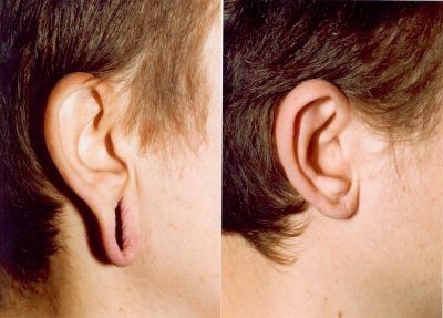LSA, do y'all have attached or detached earlobes? Attached vs. Detached