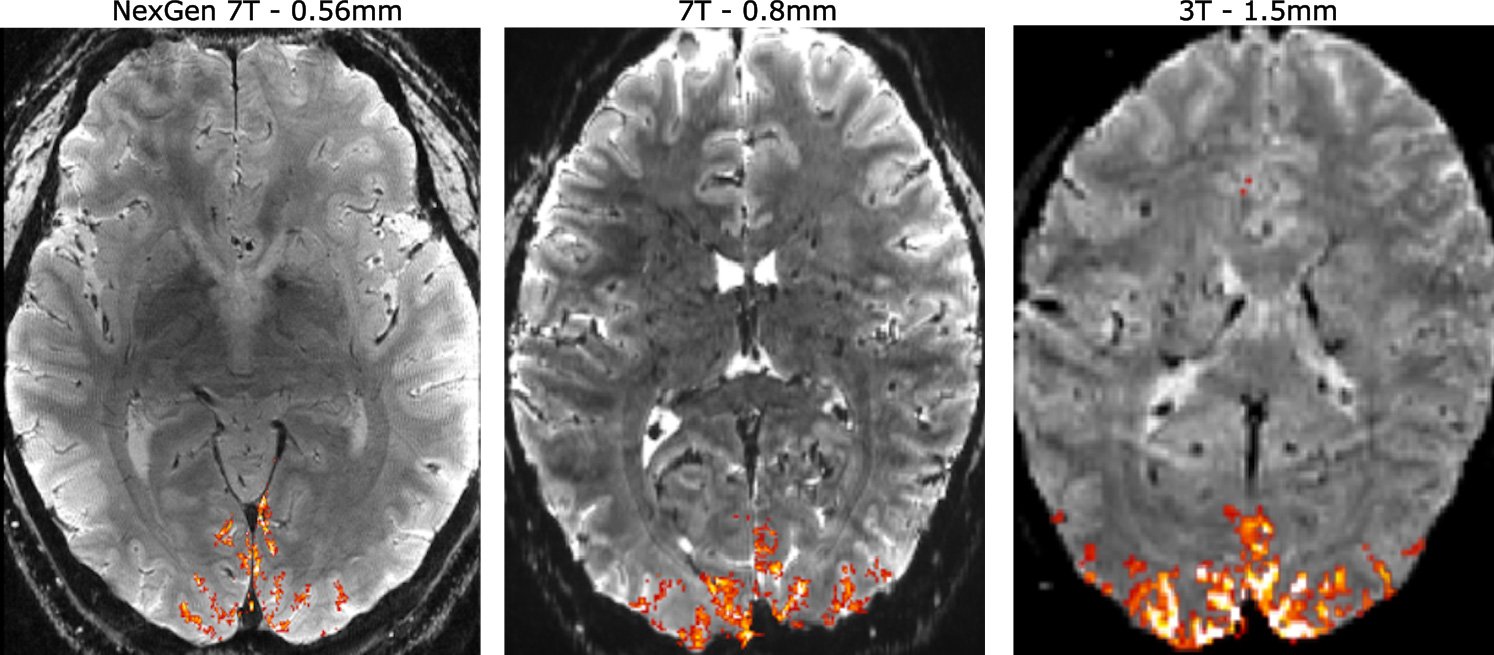 Next-Gen fMRI Improves Spatial Resolution 10-Fold - IEEE