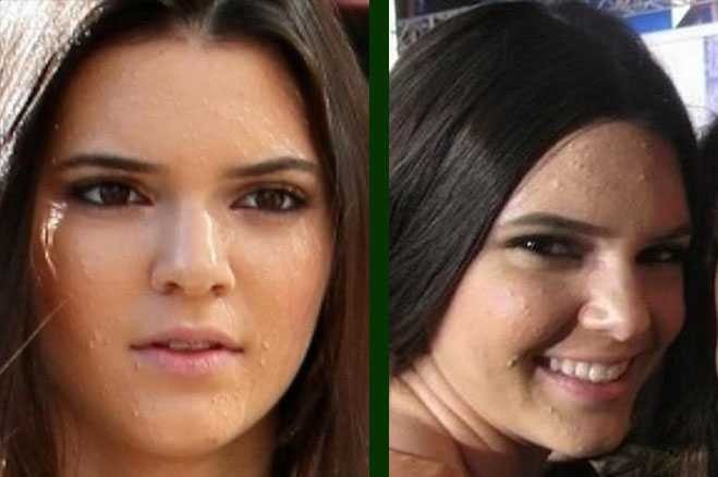 Kendall Jenner Acne : Model Candidly Reveals- 'Acne Ruined ...