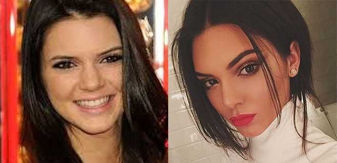 How Real Are The Kardashians Kendall Jenner Plastic