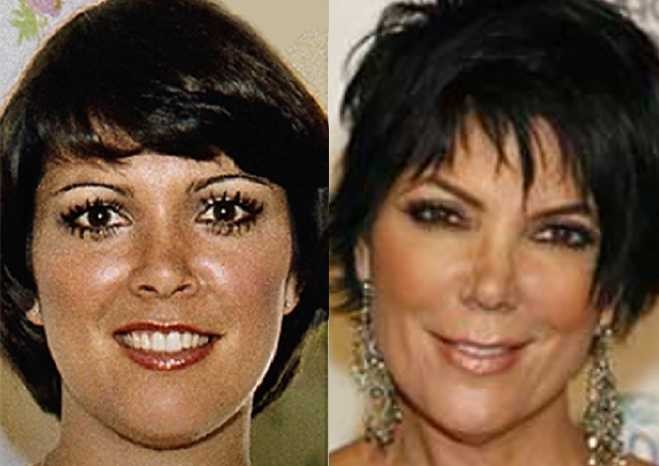 free kris jenner plastic surgery