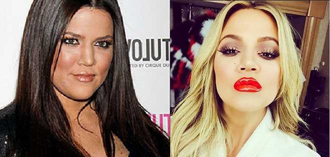 KhloeKardashian Denies Having Fillers—Because Liar Lair Pants On Fire ...