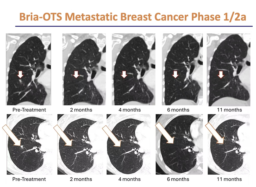 Briacell series of lung CT scans over time with arrows indicating changes, labeled Pre-Treatment to 11 months; Text reads: Bria-OTS Metastatic Breast Cancer Phase 1/2a.
